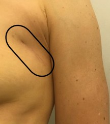 Scar_arm-down